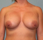 Breast Augmentation