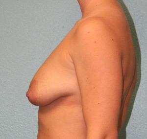 Breast Augmentation