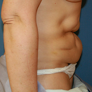 Tummy Tuck