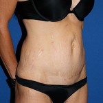 Tummy Tuck