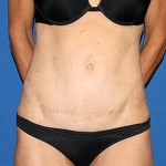 Tummy Tuck