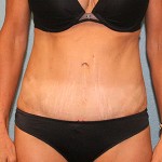 Tummy Tuck