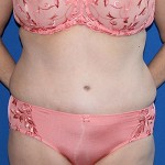 Tummy Tuck