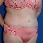 Tummy Tuck