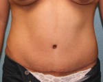 Tummy Tuck