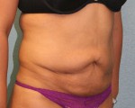 Tummy Tuck