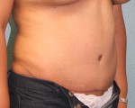 Tummy Tuck