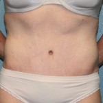 Tummy Tuck