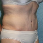 Tummy Tuck