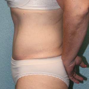 Tummy Tuck