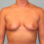 Breast Augmentation