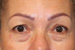 Eyelid Surgery