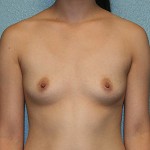 Breast Augmentation