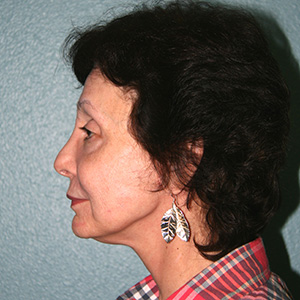 Neck Lift