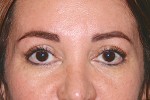 Eyelid Surgery