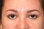 Eyelid Surgery