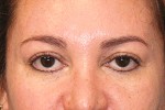 Eyelid Surgery