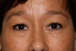 Eyelid Surgery