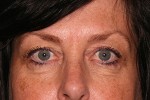 Eyelid Surgery