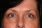 Eyelid Surgery