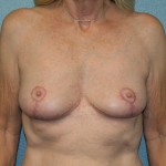 Breast Lift