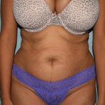 Tummy Tuck