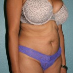 Tummy Tuck