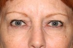 Eyelid Surgery