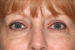 Eyelid Surgery