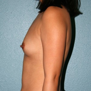 Breast Augmentation