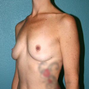 Breast Augmentation