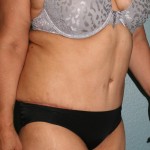 Tummy Tuck