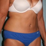 Tummy Tuck