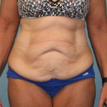 Tummy Tuck