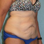 Tummy Tuck