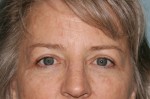Eyelid Surgery