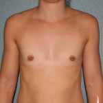 Breast Augmentation