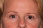 Eyelid Surgery