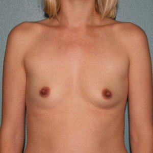 Breast Augmentation