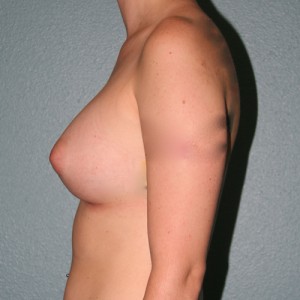 Breast Augmentation