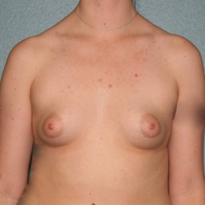 Breast Augmentation