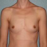 Breast Augmentation