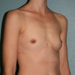 Breast Augmentation
