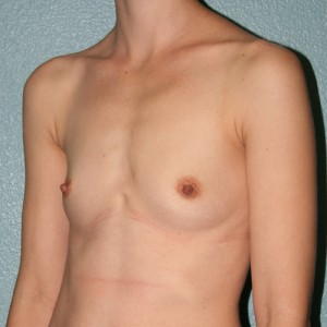 Breast Augmentation