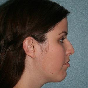 Nose Surgery (Rhinoplasty)