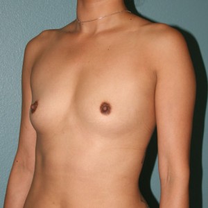 Breast Augmentation