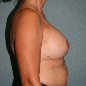 Breast Augmentation