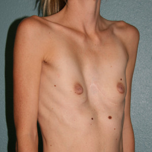 Congenital Breast Surgery