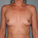 Breast Augmentation