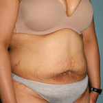 Tummy Tuck